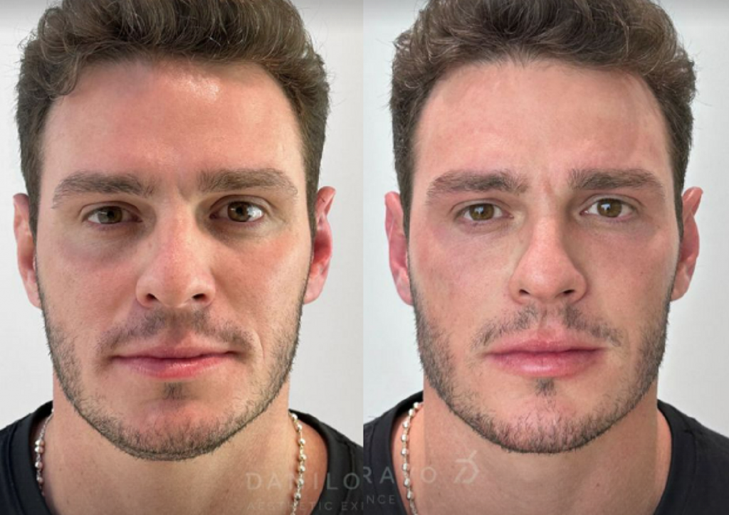 Ex-participante do 'BBB 23' faz harmonização facial; confira resultado –  www.vitrinestoreblog.com.br